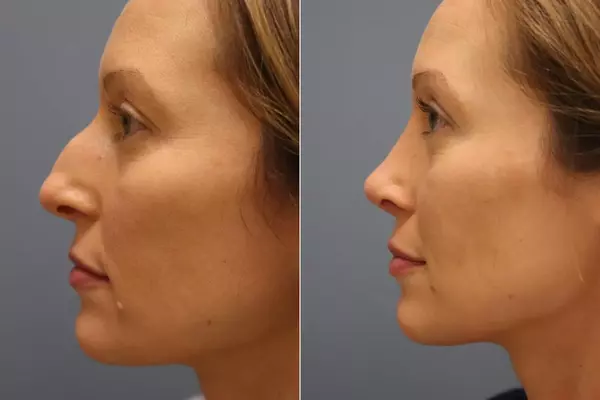 Correction of a nasal bump