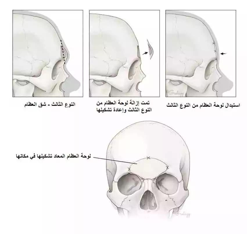 ما هي جراحة تصغير الجبين (شد الجبين أو نحت الجبين)