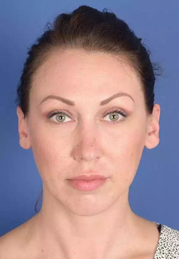 صور لتخفيض خط الشعر وتصغير الجبهة قبل وبعد في إيران