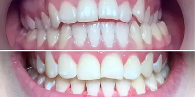 تقويم الأسنان في مدينة طهران