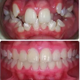 تقويم الأسنان في إيران