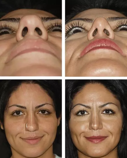 Illustration of refining or reducing a bulbous nasal tip