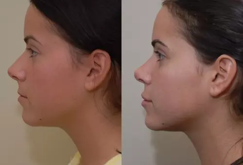Result of a rhinoplasty procedure