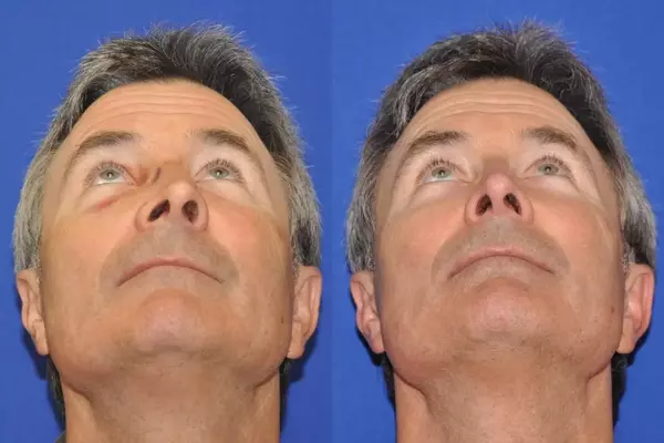 Illustration of a closed reduction procedure