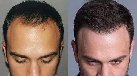 زراعة الشعر في ايران بمدينة يزد