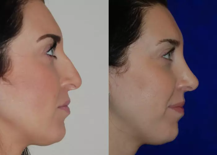 Illustration of a rhinoplasty procedure