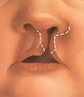 Cleftlip Palate Repair in Shiraz