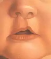 Cleftlip Palate Repair in Yazd