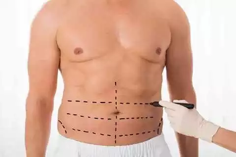 Abdominal etching procedure