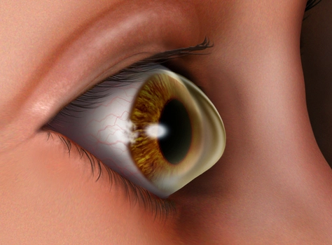 CORNEAL TRANSPLANT in iran