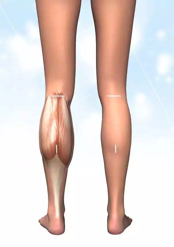 Calf Reduction Surgery in Iran