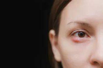 Chalazion Treatment in Iran