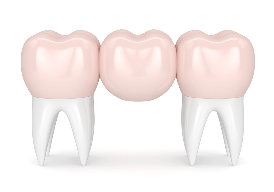 DENTAL BRIDGES IN IRAN