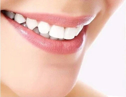 Dental Veneers in Iran