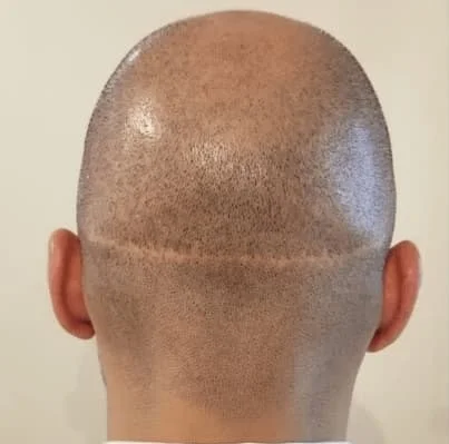Hair transplant in Iran- Shiraz