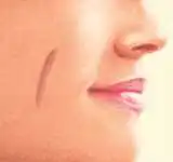 Hypertropic scars treatment in iran