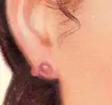 Keloids treatment in iran