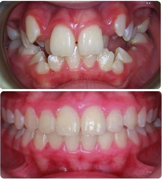 orthodontics in iran