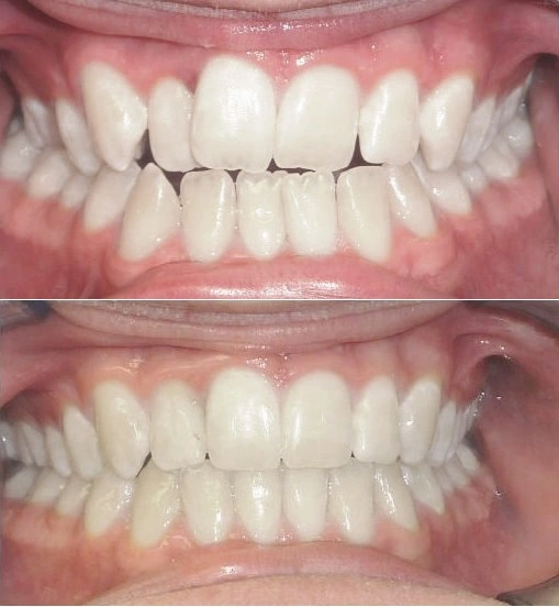 orthodontics in iran at shiraz city