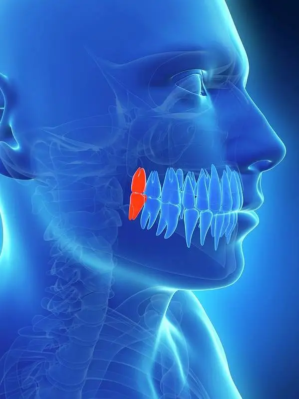 WISDOMTEETH removal in iran