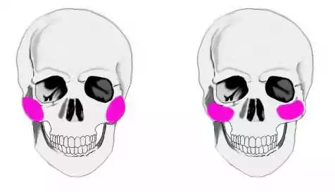 cheek implants in Iran
