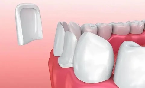 dental veneers