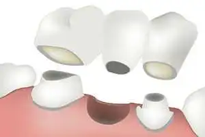 Dental bridge in Iran