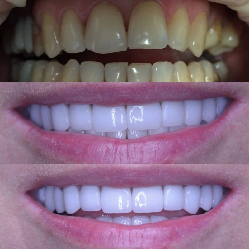 dental veneers