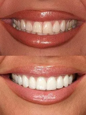 dental veneers