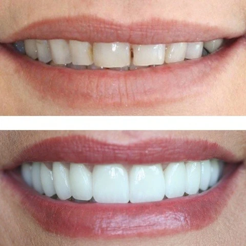 dental veneers