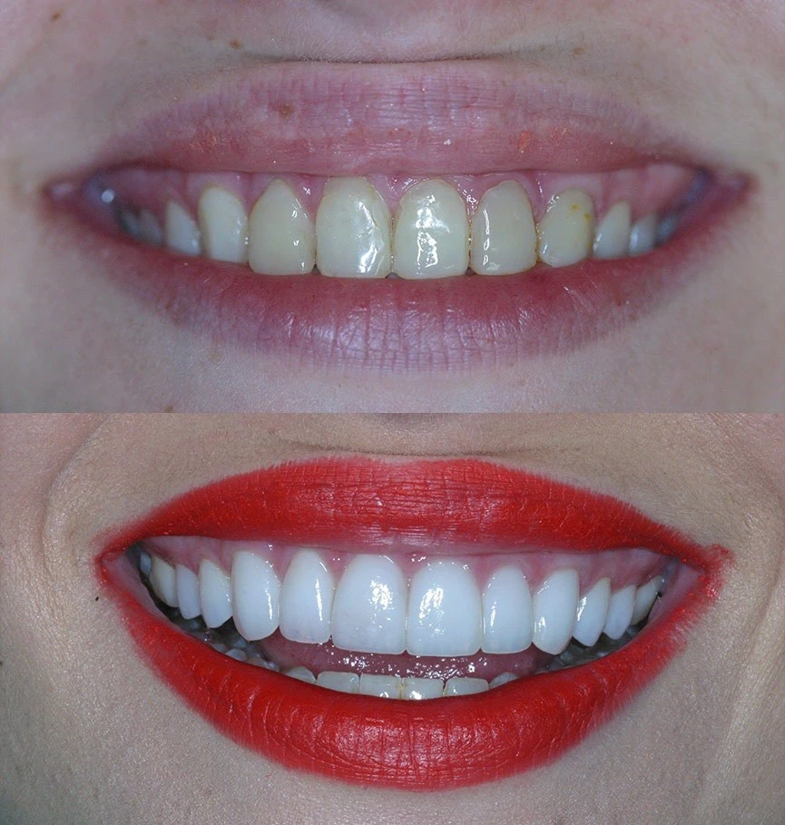 dental veneers