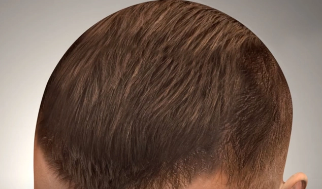 Hair transplant in Shiraz