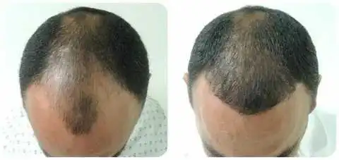 Hair transplant in Shiraz