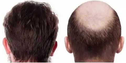 Hair transplant in Shiraz