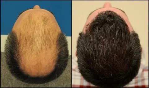 Hair transplant in Shiraz