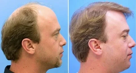 Hair transplant in Shiraz