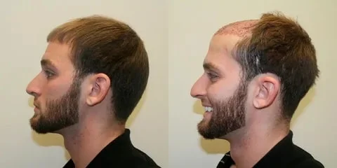Hair transplant in Shiraz