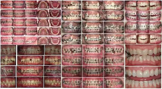 orthodontics in iran