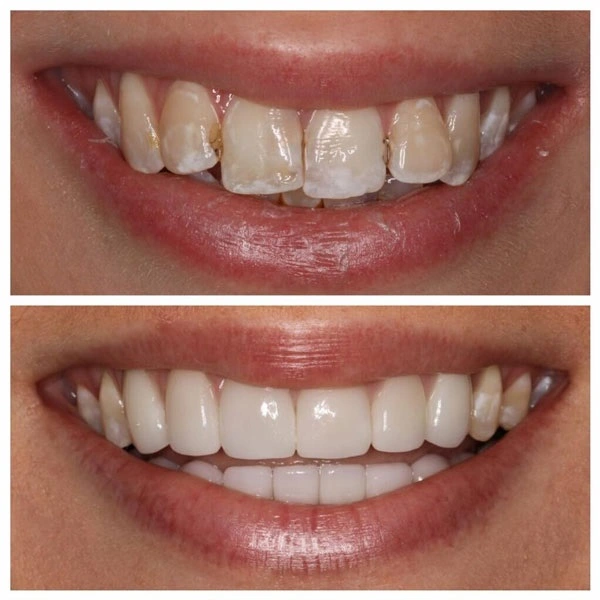 dental veneers