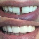 dental veneers